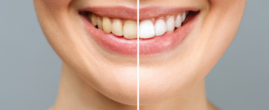 mallorie- whitening